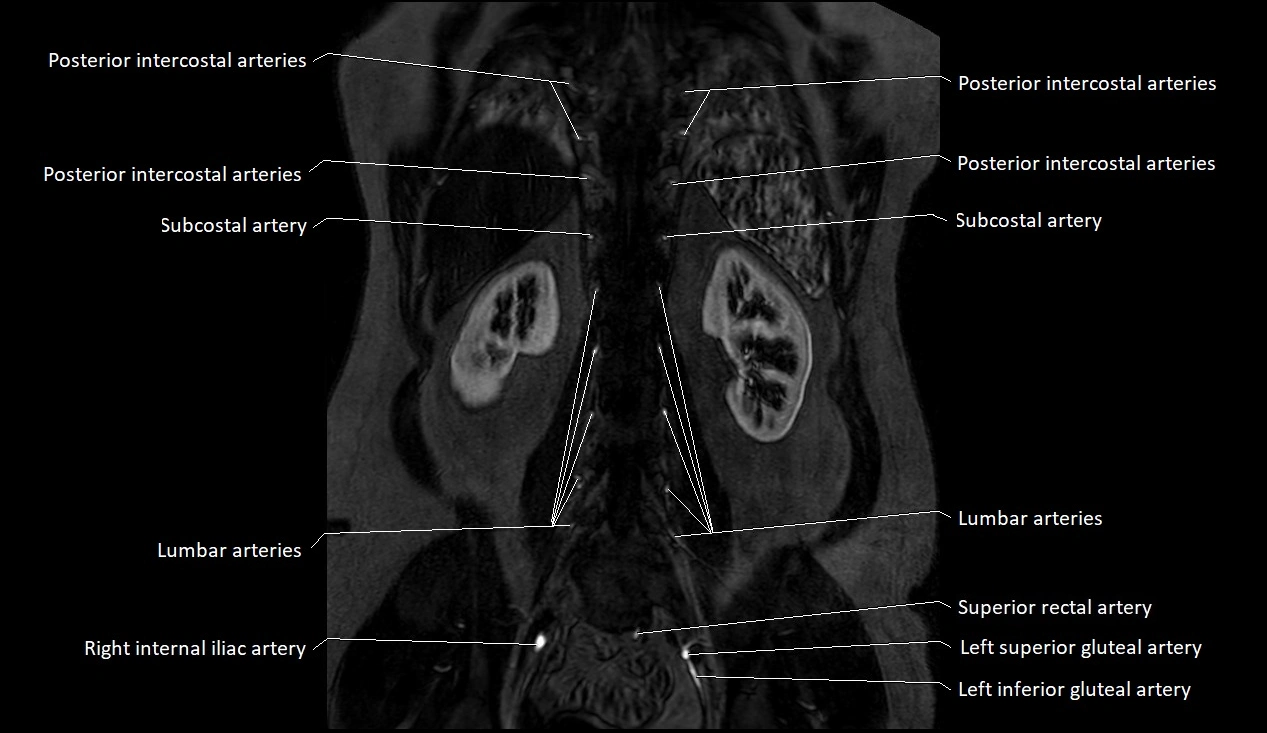 MRA Abdomen coronal anatomy image 47.webp